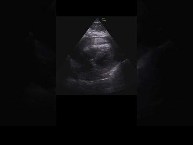 Hemopericardium #pocus #echo #echofirst #emergencymedicine #criticalcaremedicine