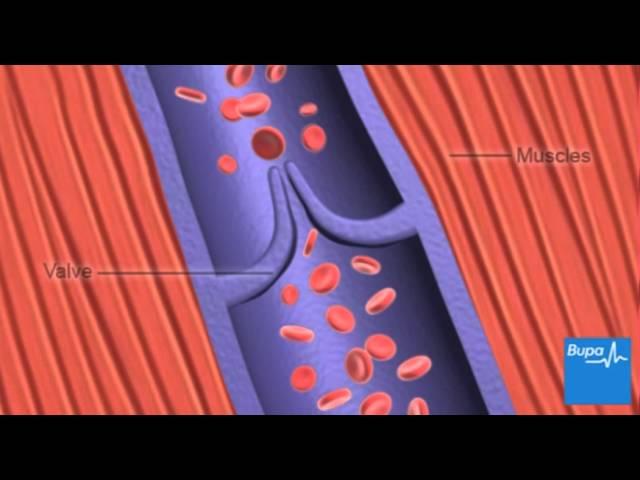 How deep vein thrombosis (DVT) forms | Bupa Health