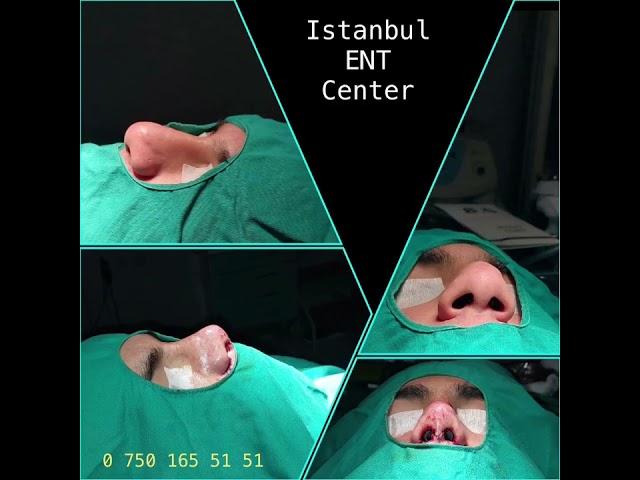 Istanbul ENT Surgeries