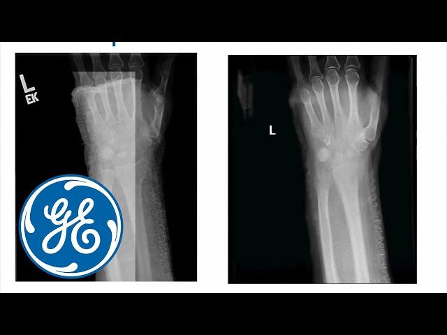 GE Healthcare X-ray: Digital X-ray Tomosynthesis: A cutting-edge technology | GE Healthcare