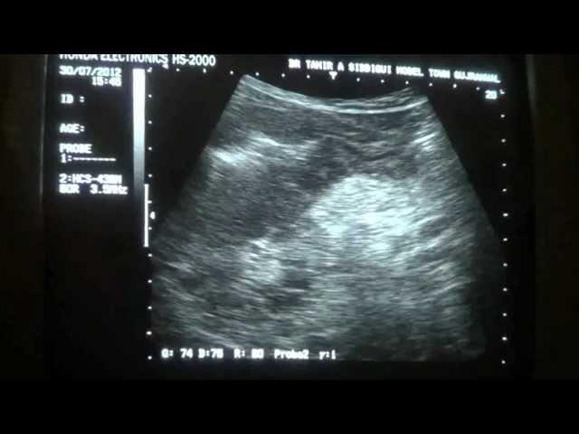 BOWEL MASS in RHC with MASS EFFECT at porta hepatis , ADENOPATHY etc