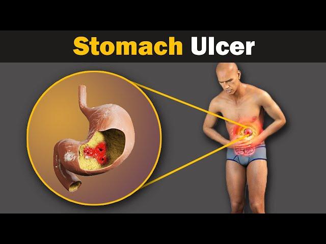 What causes a stomach ulcer? Animation