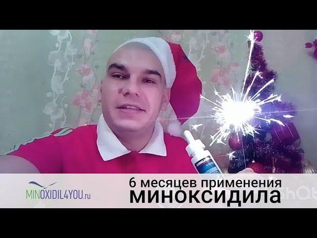 Миноксидил результат применения через 6 месяцев. Отзыв об использовании миноксидила. Minoxidil4you