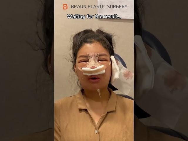 I cried when watching this... #fyp #glowup #facialcontouringsurgery #rhinoplasty #plasticsurgery