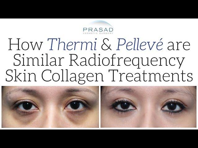 How Pelleve and Thermi Work the Same in Generating Collagen, and Other Ways to Improve the Skin