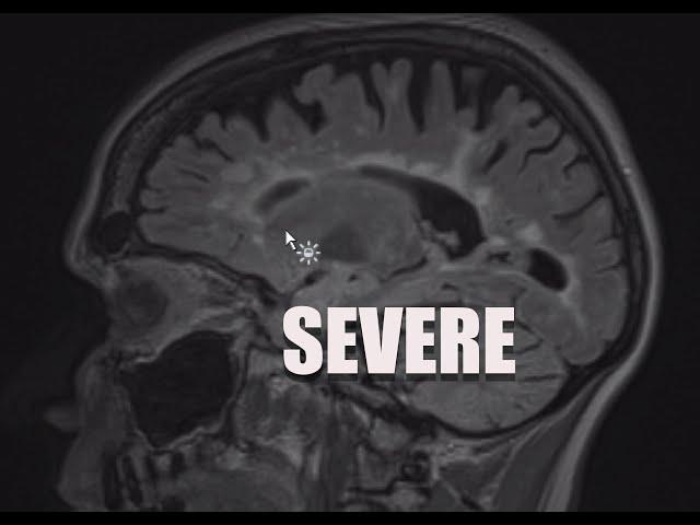 Understand Your Scan: MS MRI and Brain Atrophy