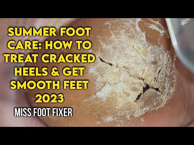 Summer Foot Care: How to Treat Cracked Heels and Get Smooth Feet by foot Specialist Miss foot Fixer