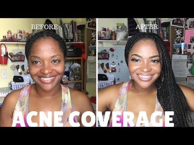 Cover Dark Spots and Cystic Acne with makeup