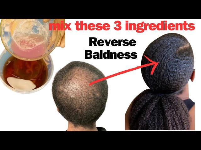 3 Powerful Ingredients For Reversing Baldness in 30 Days. Guaranteed Visible Result in Just One Use