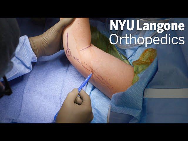 Optimizing Transhumeral Amputations