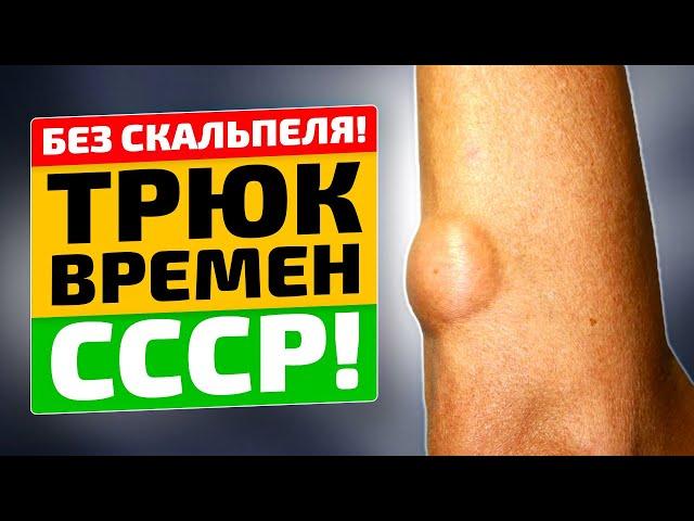 Жировик удаляется безопасно и просто! Советский способ избавления от липомы!