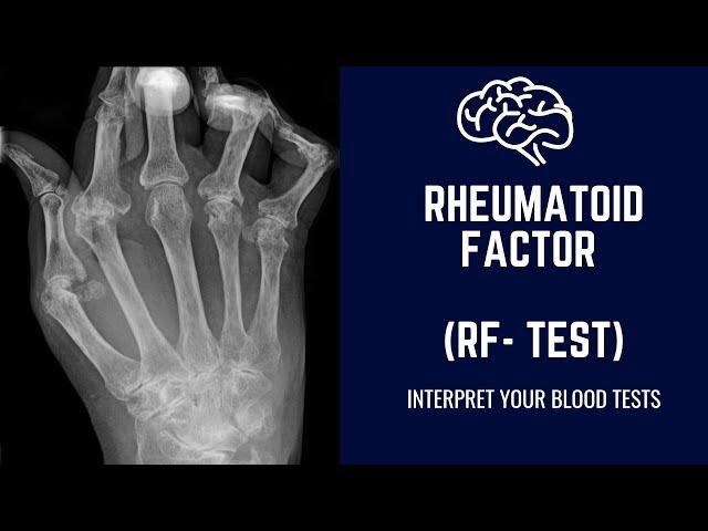 Rheumatoid Factor Test ( RF Test) :Diagnosis of  Rheumatoid Arthritis: Normal Range & Interpretation