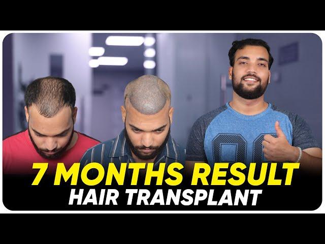 Hair Transplant in Chennai | Best Results & Cost of Hair Transplant in Chennai