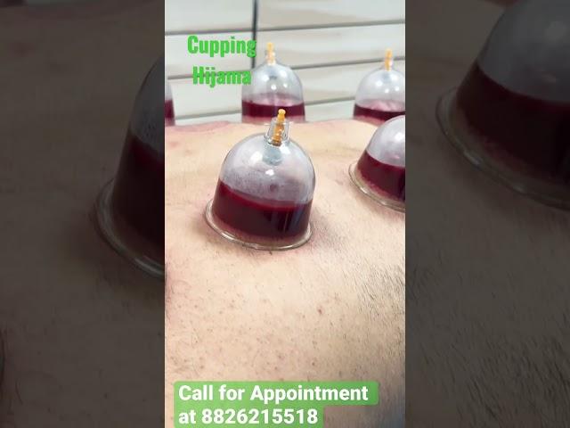 Cupping therapy | Hijama therapy treatment for body Detox: How it works