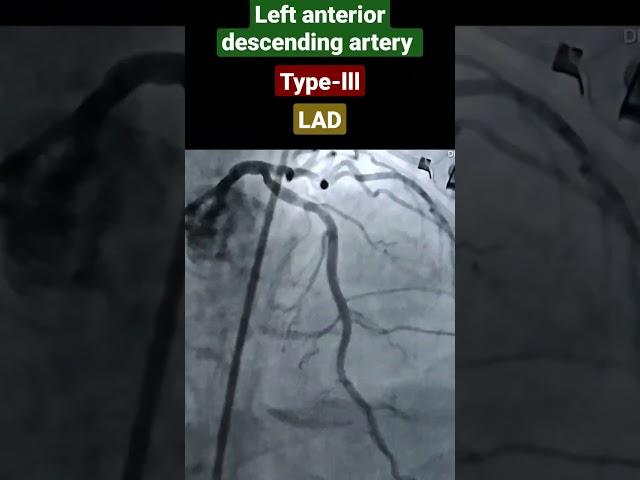 LAD, left anterior descending artery type-lll angiography, widow Maker Artery #shorts