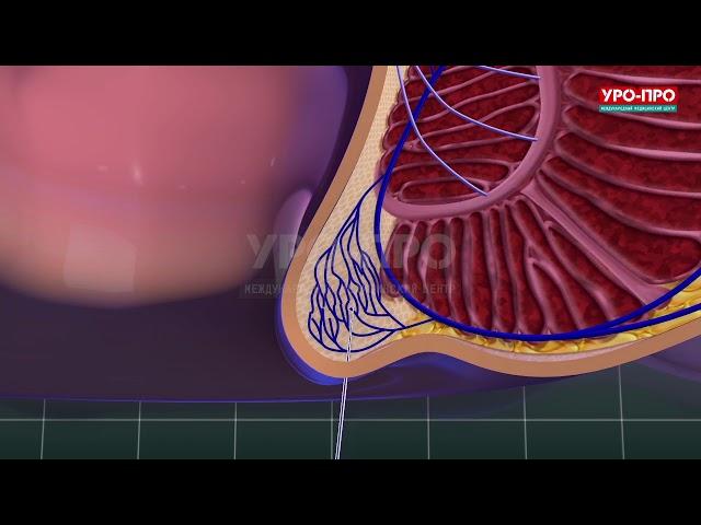Лечение геморроя лазером в клинике "УРО-ПРО"