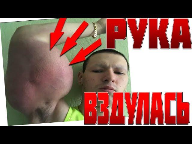 РУКИ БАЗУКИ СИЛЬНО ВЗДУЛИСЬ И ПОКРАСНЕЛИ! Кирилл Терешину АМПУТАЦИЯ РУК?