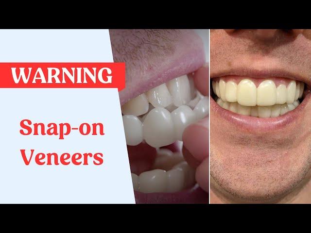 Snap On Veneers Warning