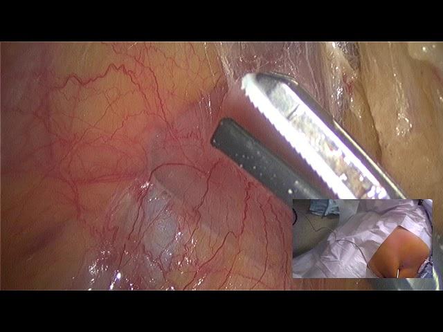 Lap Right Colectomy by Alexey Karachun, Yuriy Pelipas. Live Surgery, Tyumen, Russia, April 2018