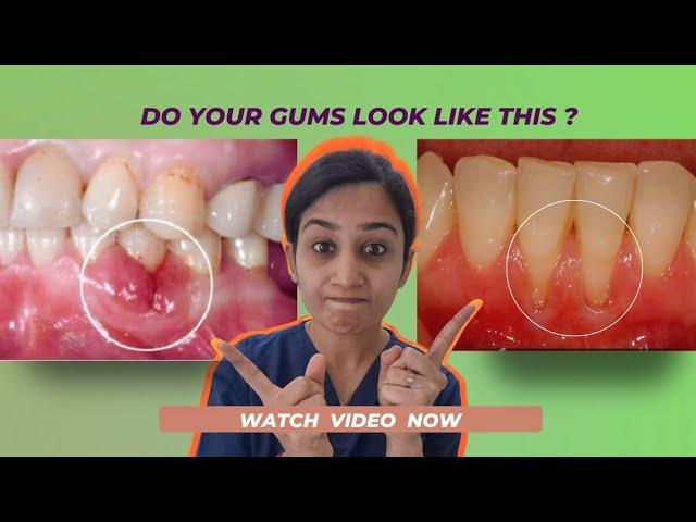 Importance of Gums Health. Why gums bleed or decrease in height and teeth losing.