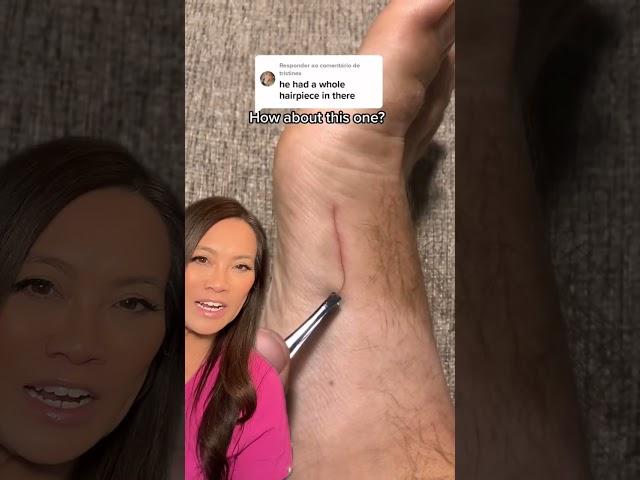 Dr Pimple Popper Reacts to Inflamed Ingrown that Looks SATISFYING to Pull Out