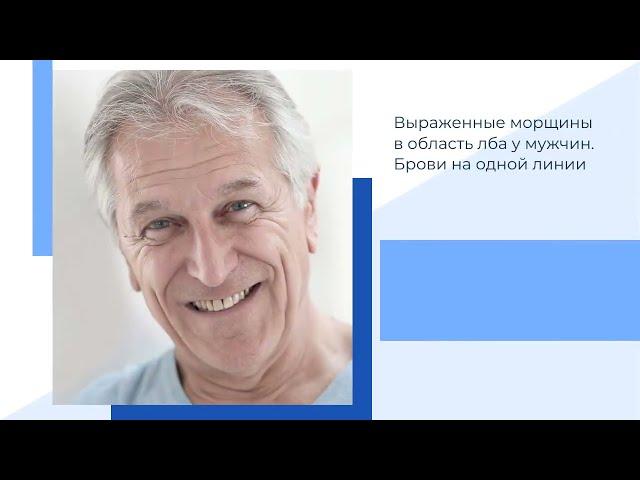 Морщины в области лба у мужчин