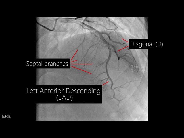 Coronary artery anatomy - Coronary angiogram