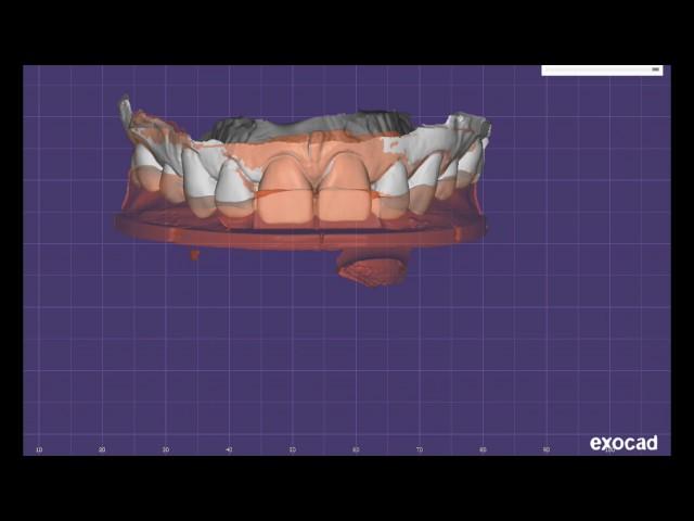 Kois dentofacial analyzer digital transfer technique