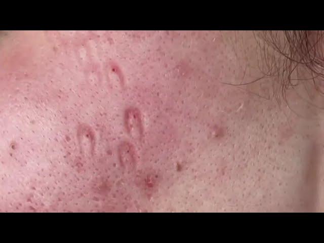 blackhead extraction  | removing cystic acne | чёрные точки | прыщи выдавливание| акне |угри