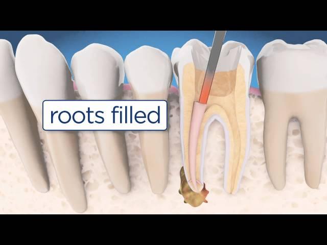 Root Canal Retreatment Explained