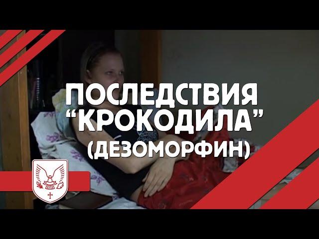 Последствия "КРОКОДИЛА" (Дезоморфин) Выход есть!