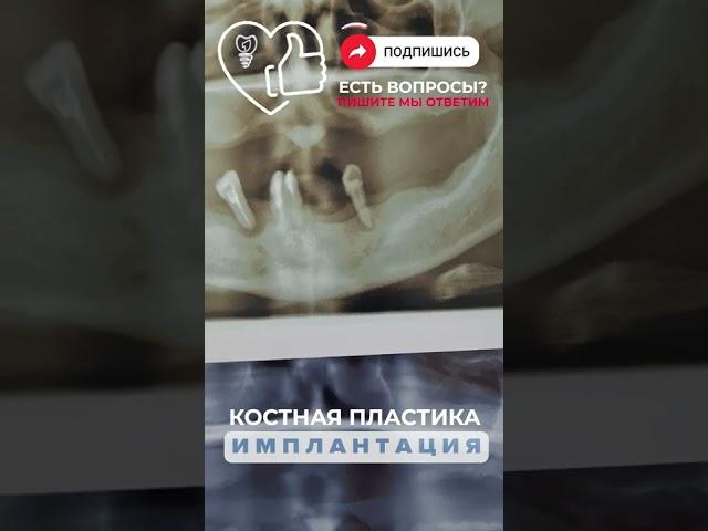 Костная пластика и имплантация.