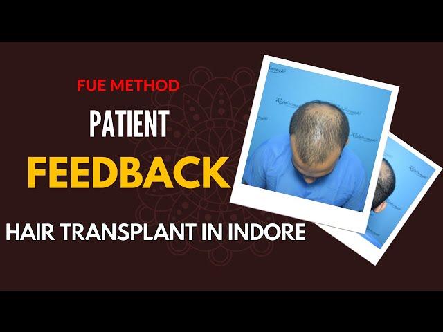 Best Hair Transplant in Indore | Patient From Indore, | FUE Method | 2024