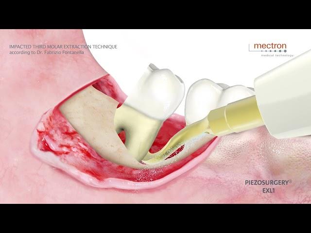 PIEZOSURGERY® - Dr. Fabrizio Fontanella - Impacted third molar extraction technique