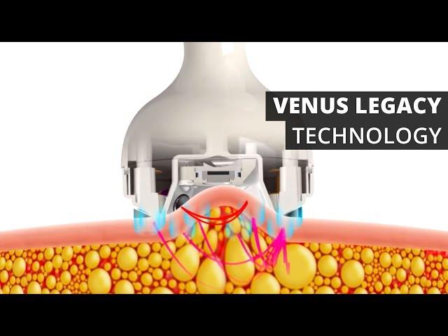 Venus Legacy™ Technology