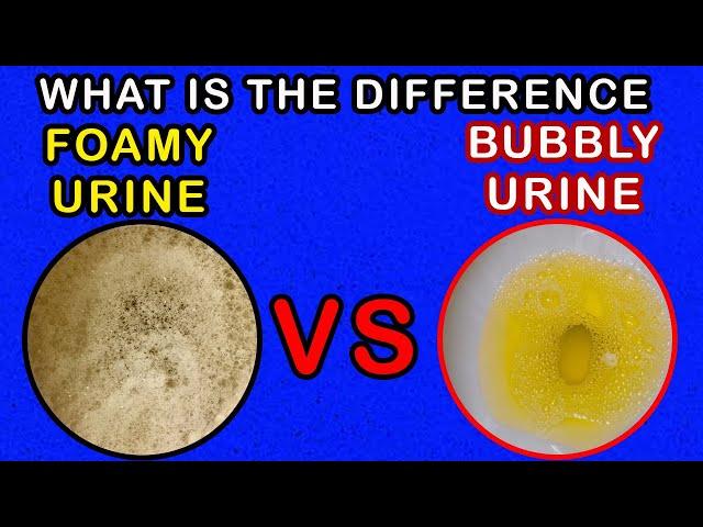 Differences between Foamy Urine Vs Bubbly Urine