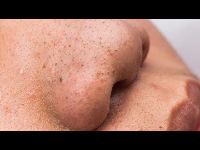 Relaxing Acne Treatment Everyday With Vu Quynh Mi Spa|Blackheads Removal| Cystic Removal 2023 |#05