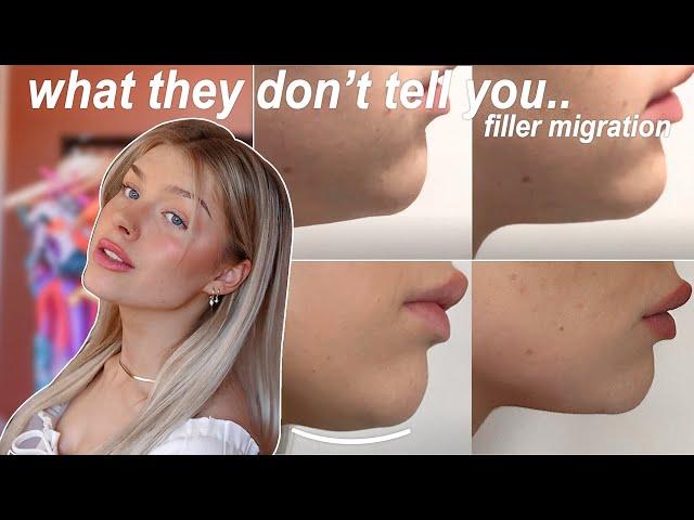 chin filler 3 years later | filler migration, what they don't tell you..