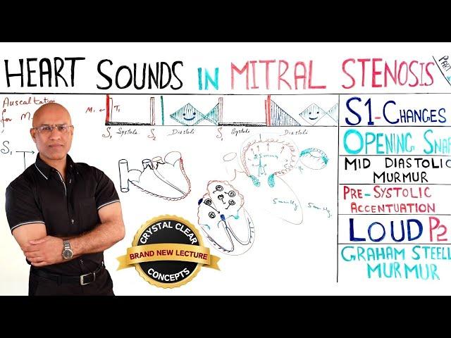 Heart Sounds in Mitral Stenosis | s1 | Cardiology