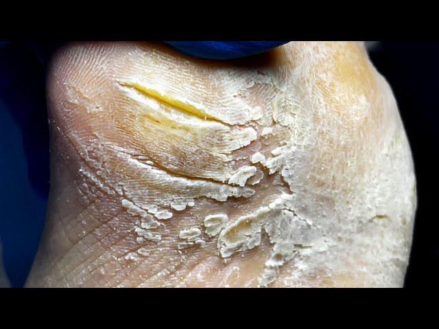 There Are Many Dry Calluses On The Soles Of Feet, How To Solve The Problem【Pedicure Master Lin Jun】