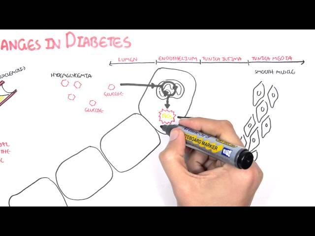 Diabetes Complication and Pathophysiology of the complication