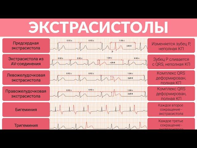 ЭКГ Разбор Экстрасистолы