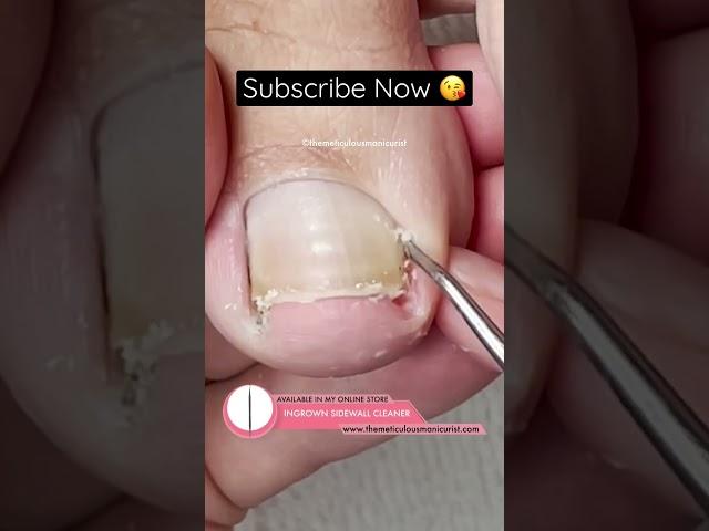 I can’t stop watching this video! #satisfying #ingrowntoenail #pedicure #pedicuretraining