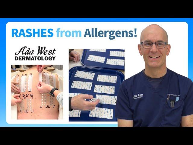 Patch testing for skin allergy in Boise with Ada West Dermatology