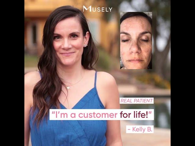 How To Treat Stubborn Melasma For Less Than $1 a Day | Musely FaceRx