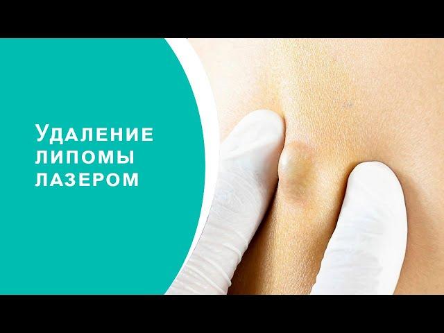 Удаление липомы лазером