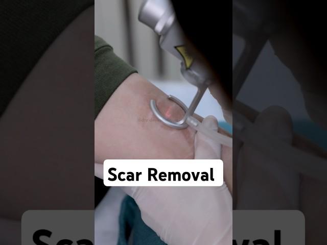 How to Get Rid of Scars | Procedure for Scar Removal | #Scarremoval #DrSridevi