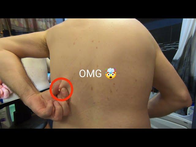 Insane Back Pimple Bursting Extravaganza