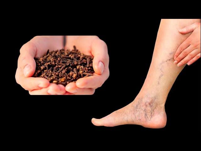 Incredible!  This Remedy Destroys Varicose Veins! Say Goodbye to Them Forever!