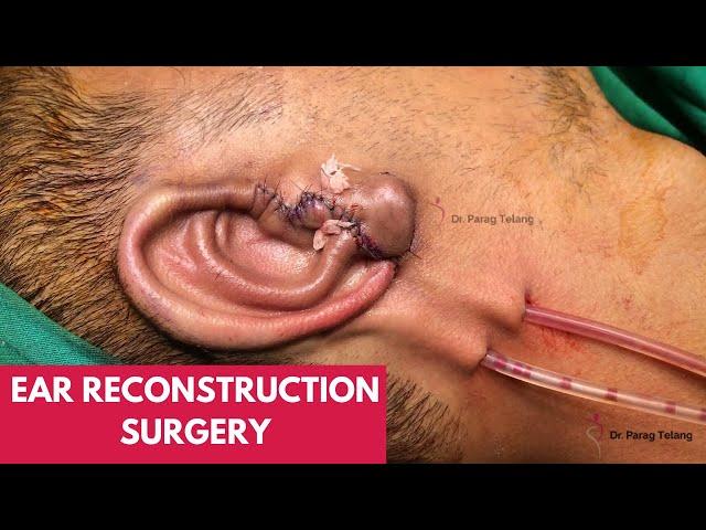 Microtia reconstruction by Dr Parag Telang